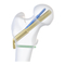 Depuy Synthes Femoral Neck System