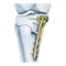 Medizinische Ausstattung Depuy Synthes TomoFix Mediale Tibiakopfplatte Handbuch